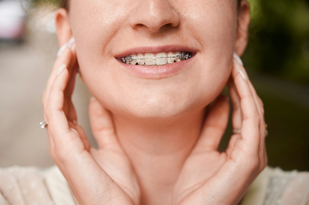 Invisible Braces for Adults in Langley